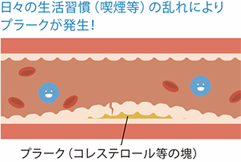 日々の生活習慣（喫煙等）の乱れによりプラークが発生！